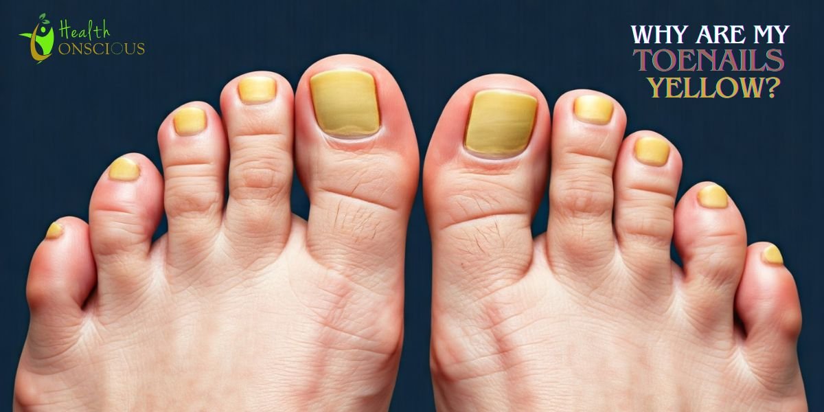 Why Are My Toenails Yellow? Common Causes, Treatments, and Prevention