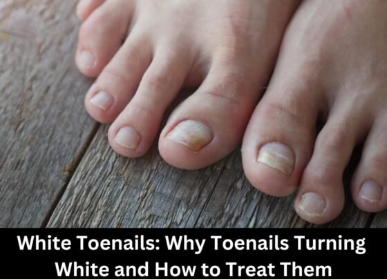 White Toenails: Why Toenails Turning White and How to Treat Them