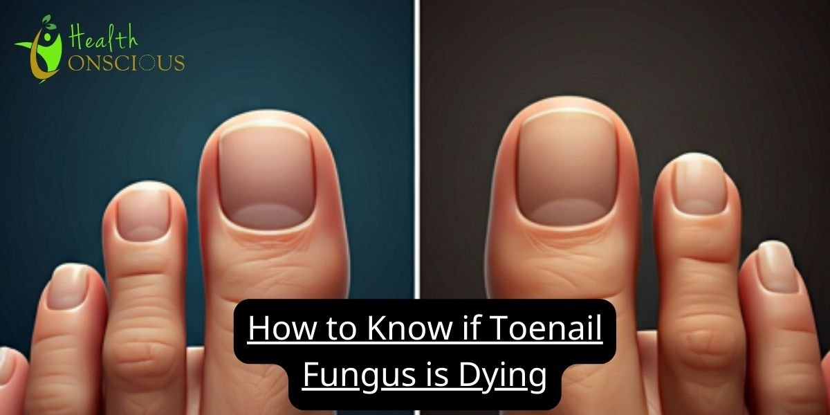 How to Know if Toenail Fungus is Dying: Signs and Treatment for Dead Toenail Fungus