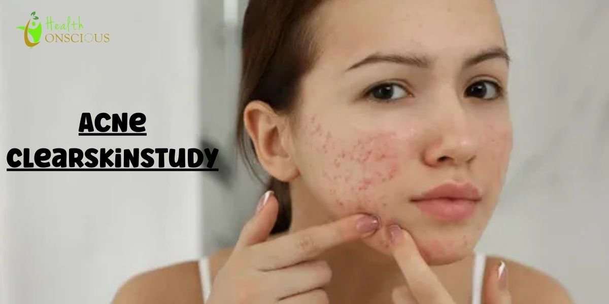 Acne ClearSkinStudy: Personalized Treatment for Clear Skin