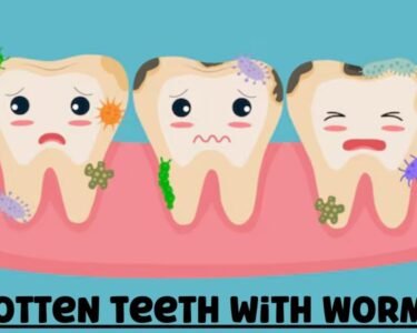 Rotten Teeth with Worms