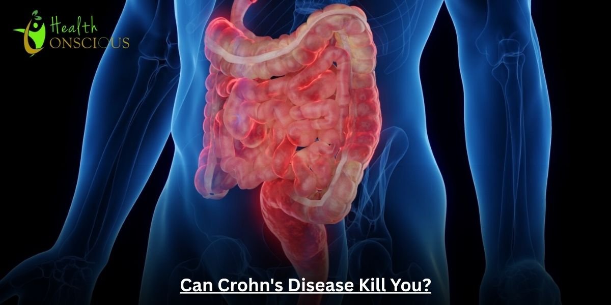 Can Crohn’s Disease Kill You? Symptoms, Complications & Outlook