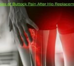 Causes of Buttock Pain After Hip Replacement