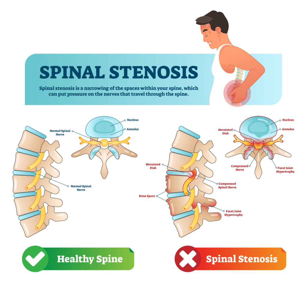Healthy Spine vs Spinal Stenosis