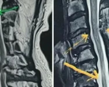 What Is Post Laminectomy Syndrome