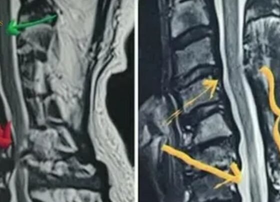 What Is Post Laminectomy Syndrome