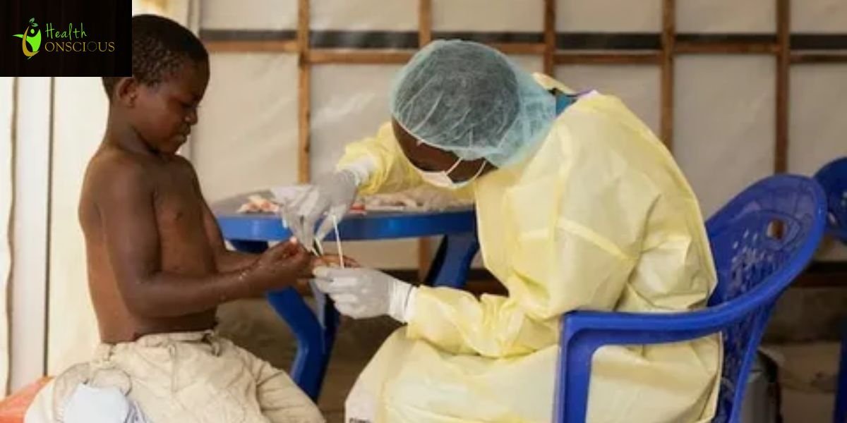 First U.S. Cases of Clade I Mpox Without Travel History Found in Los Angeles County