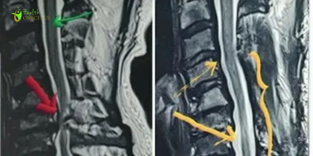 What Is Post Laminectomy Syndrome