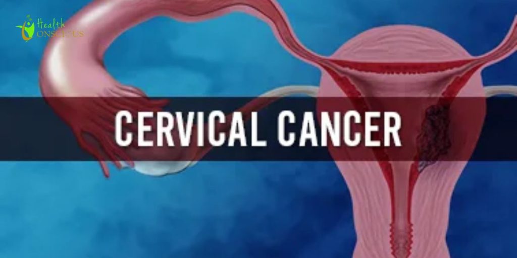 Cervical Cancer