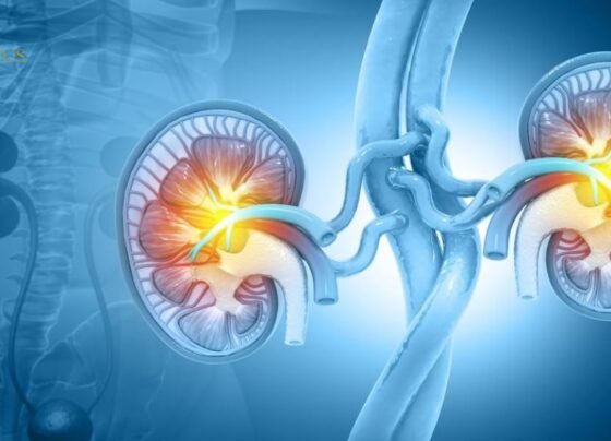 Chronic Kidney Disease Ranks Among Top 10 Global Causes of Death, New Analysis Reveals