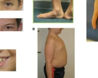 How to Deal With Sudenzlase Syndrome?