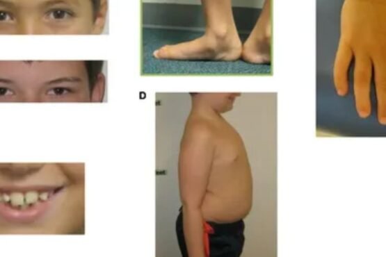 How to Deal With Sudenzlase Syndrome?