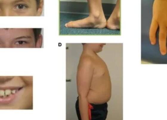 How to Deal With Sudenzlase Syndrome?