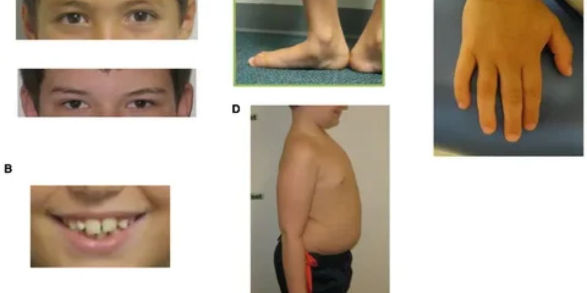 How to Deal With Sudenzlase Syndrome?